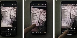 iPhone camera for cervical spondylitis